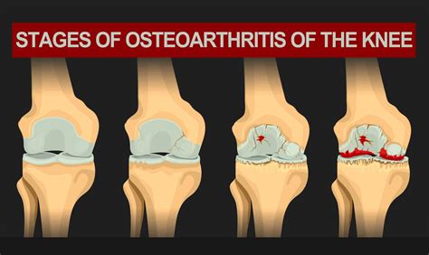 wear and tear osteoarthritis